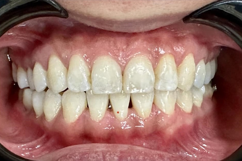 Clear Aligner