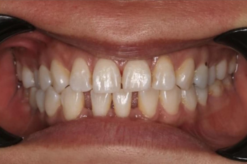 Clear Aligner