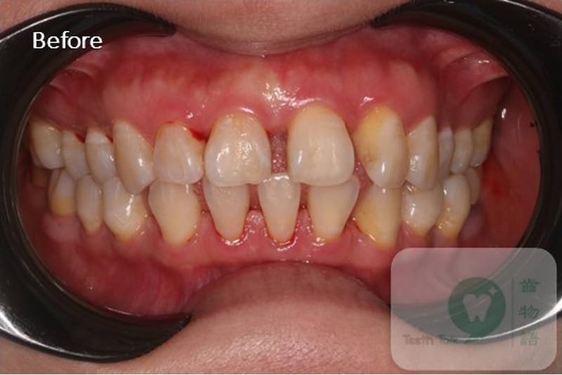 Clear Aligner