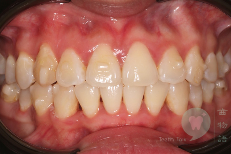 Clear Aligner