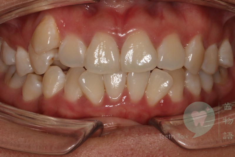 Clear Aligner