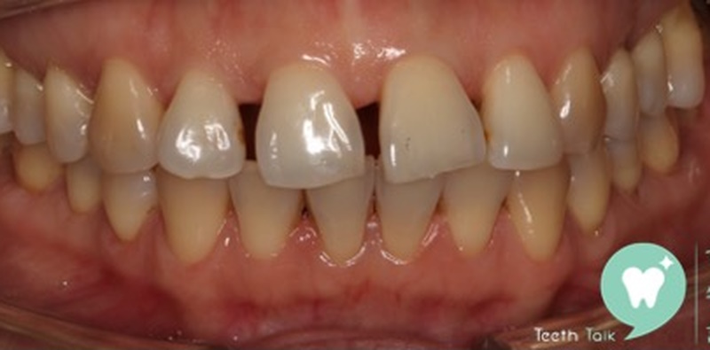 Prosthodontic Treatment